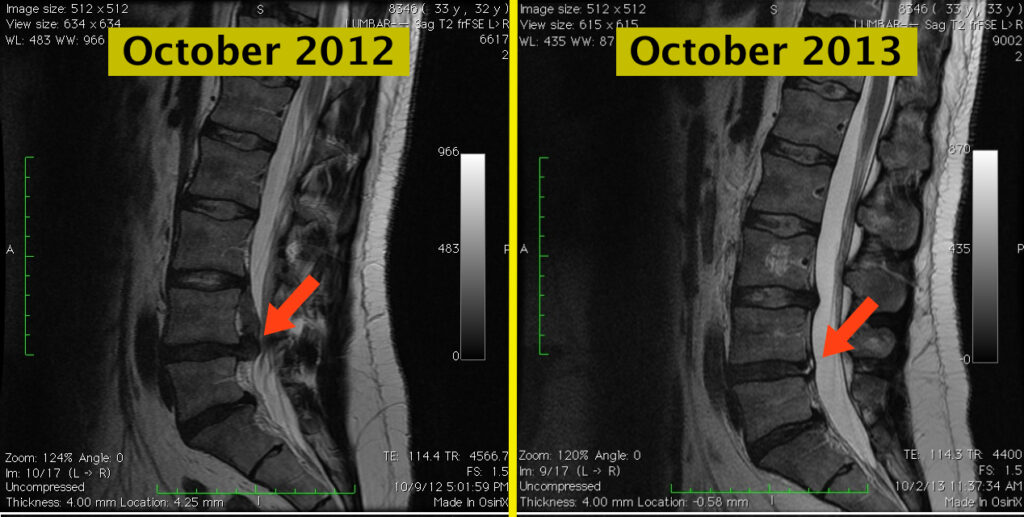 Resorption of lumbar herniated disc